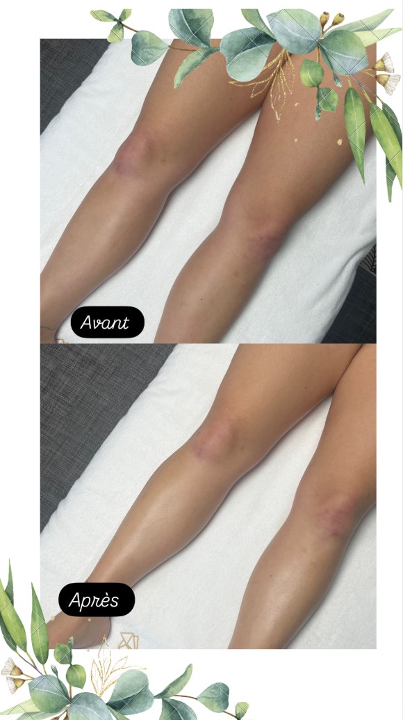 Cellulite : Découvrez les solutions qui fonctionnent !