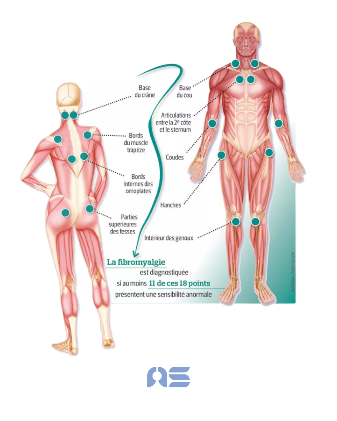Sophrologie et fibromyalgie : retrouver des ressources face aux douleurs invisibles