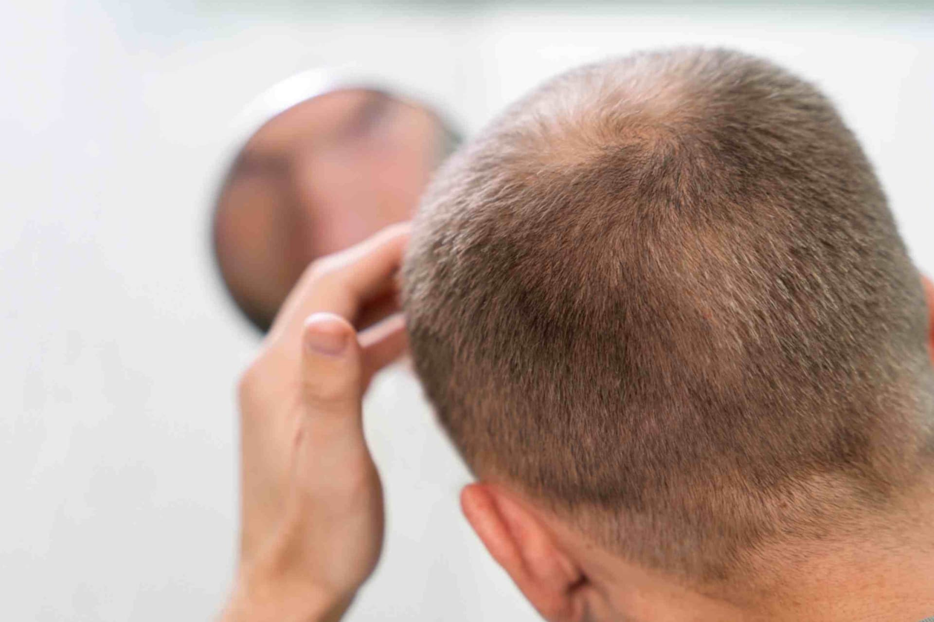 Tout savoir sur le shock loss après une greffe de cheveux